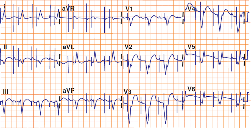 ECG ventricular paced rhythm, old anteroseptal STEMi myocardial infarction, DDD pacing, septal q wave, Cabrera sign