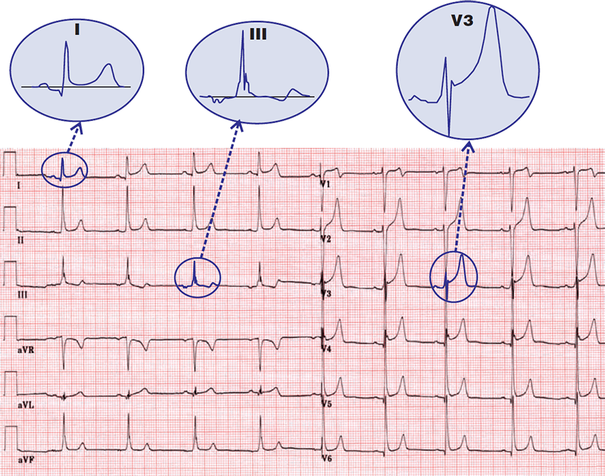 ECG benign early repolarisation, concave ST elvation, fish hook pattern, ST / T ratio