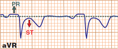 ECG pericarditis PR PQ segment elevation and ST depression