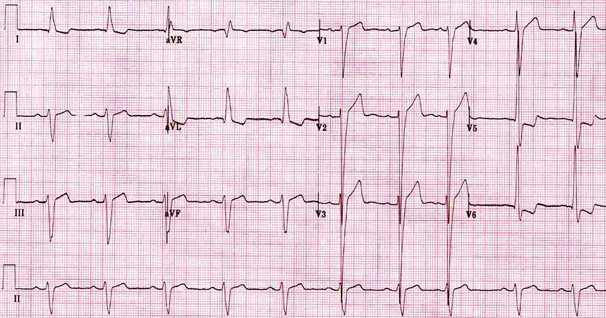 ECG left ventricular hypertrophy (LVH), voltage criteria, increased LV voltages, r wave peak time, LV strain pattern, ST elevation, left axis deviation