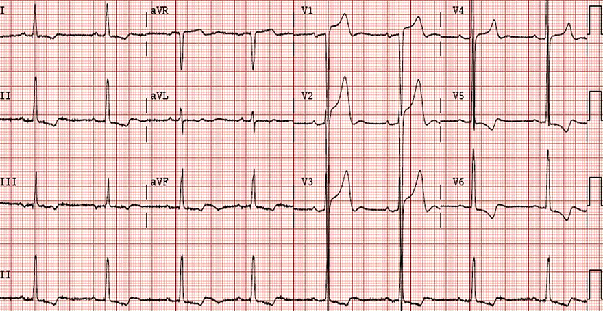 ECG left ventricular hypertrophy, sokolov criteria, increased QRS voltages, discordance ST elevation, LV strain pattern