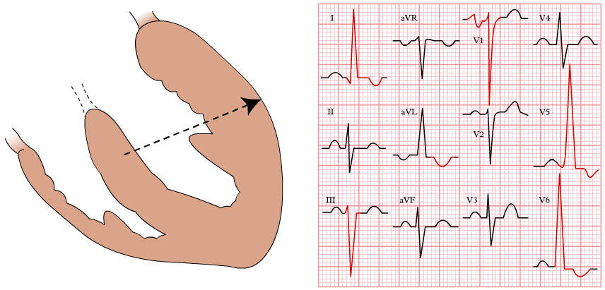 ECG left ventricular hypertrophy, voltage criteria, sokolov lyon ciretir, lewis index, r wave in aVL, increased r wave peak time