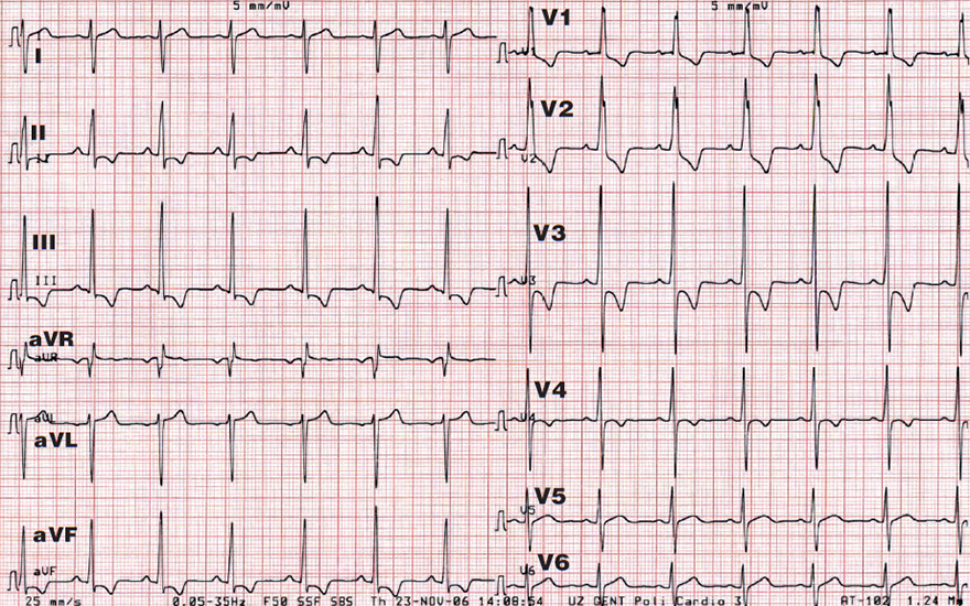 ECG right ventricular hypertrophy, Right axis deviation, Dominant R wave in V1, Dominant S wave in V6, Right ventricular strain pattern with ST depression and T-wave inversion in V1-4