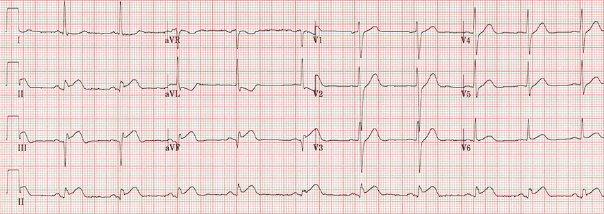 ECG acute inferior STEMI, inferior wall aneurysm formation