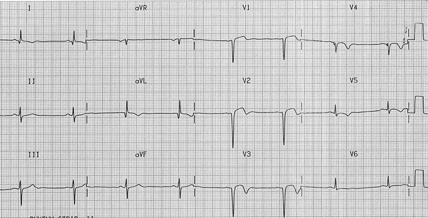 ECG anterior Left Ventricular Aneurysm, Minimal ST elevation (V1-V3), deep Q waves and T waves inversion