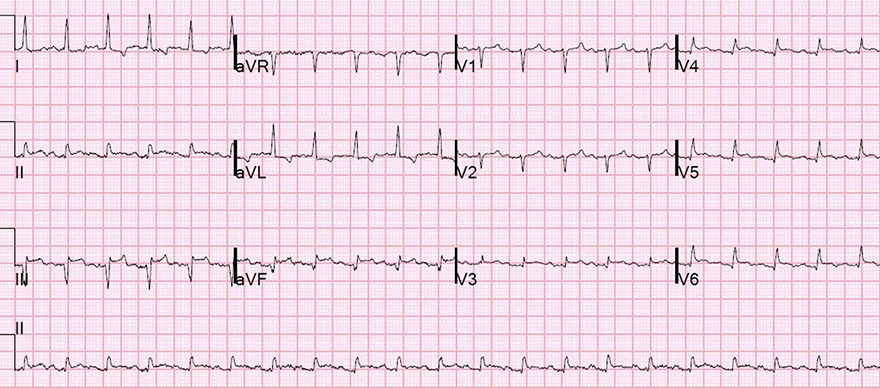 ECG Inferior Left Ventricular Aneurysm, old inferior STEMI, persistent ST elevation