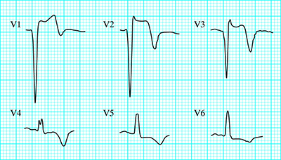 ECG criteria left ventricular aneurysm after STEMI, persistent ST elevation