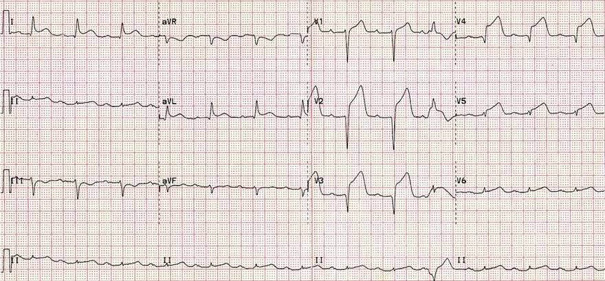 ECG acute anterior STEMI infarction, anterior aneurysm formation