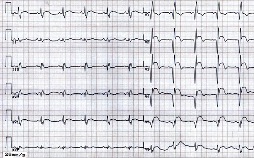 ECG old anterior myocardial STEMI infarction, persistent ST elevation, left ventricular aneurysm