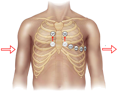 Chest electrodes Brugada syndrome (V1, V2), changed V1, V2 positions to 2nd intercostal space