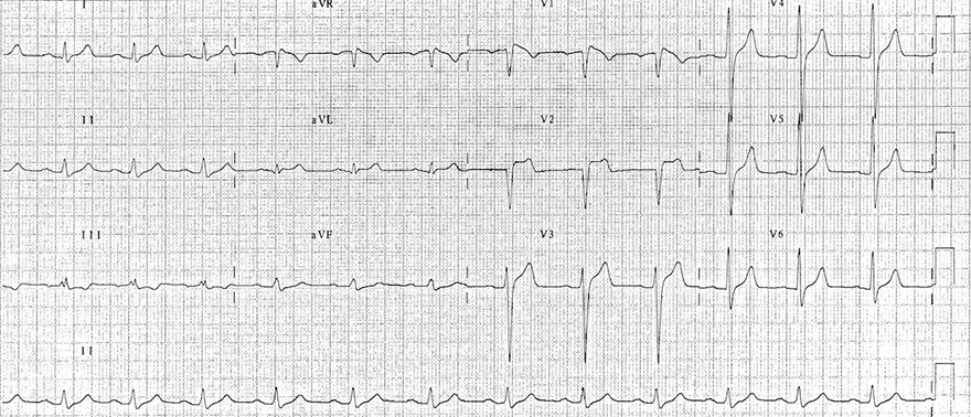 ECG criteria Brugada syndrome type 3, J wave, ST segment, T wave