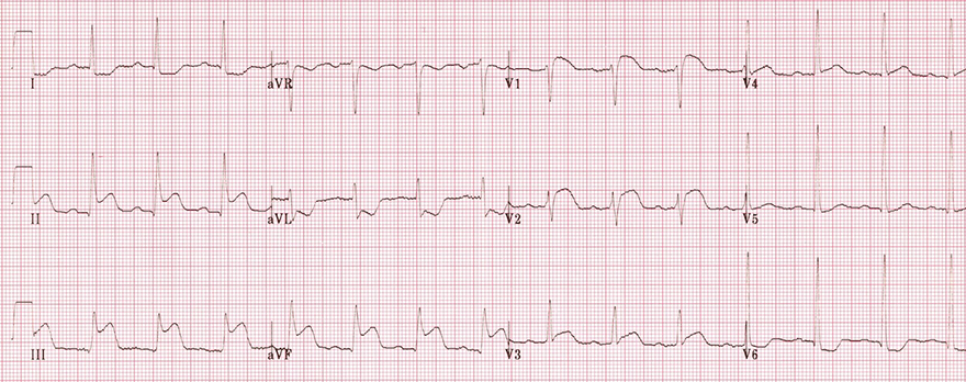 Acute STEMI infarction right ventriculcular, and inferior STEMI infarction, acute proximal occlusion right coronary artery