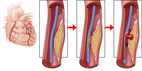 acute proximal LAD stenosis, Wellens syndrome