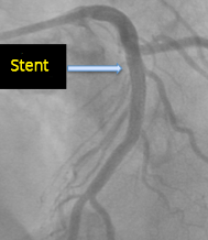 Wellens syndrome, critical stenosis LAD after complete recanalization after stent