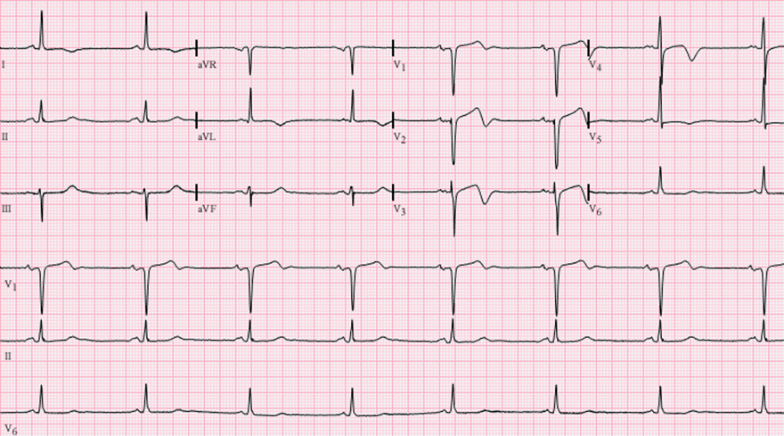 Wellens Syndrome - ECG book