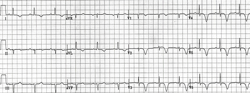 ECG Wellens syndrome type B (type I), deep symmetrical T wave infersion