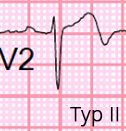 Wellens Syndrome - ECG book