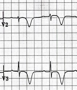 ECG Wellens syndrome type I (Type B), deeply symmetrically inverted T waves