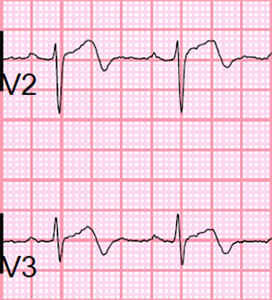 ECG wellens syndrome Type II (Type A), Biphasic T wave