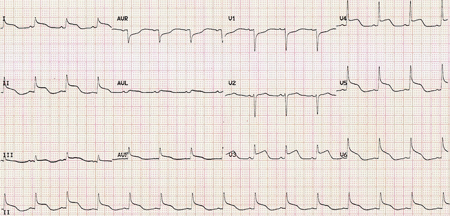 ECG traumatic brain injury, raised intracranial pressure