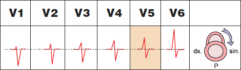 ECG precordial leads and Clockwise (CW) rotation, cor pulmonale, pulmonary embolism