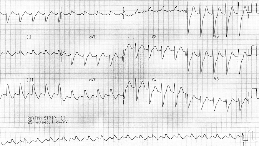 ECG acute pulmonary embolism, sinus tachycardia, right bundle branch block (RBBB), right axis deviation