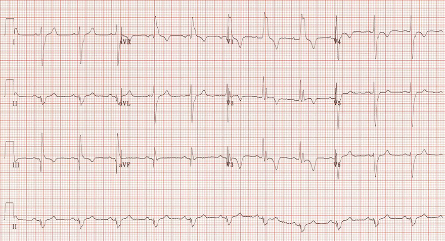 Pulmonary Embolism - ECG book