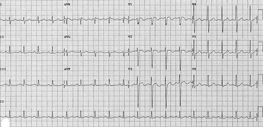 ECG acute pulmonary embolism, sinus tachycardia, S1Q3T3, negative T wave