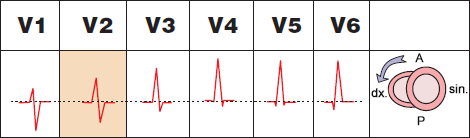 ECG precordial leads and Counterclockwise (CCW) rotation, Early transition zone