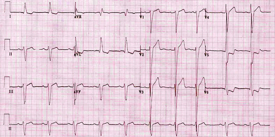 ECG left ventricular hypertrophy and Clockwise (CW) rotation, Delayed transition zone, Late transition zone