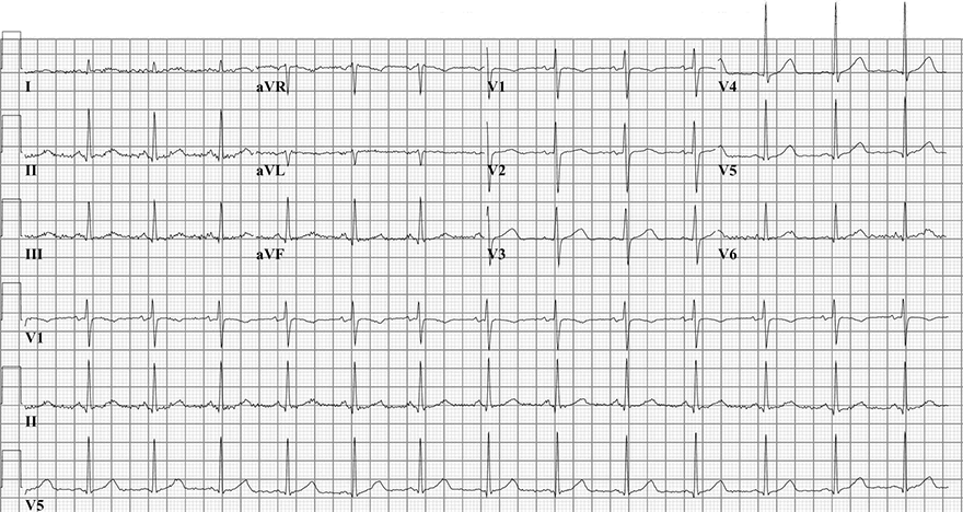 ECG sinus rhythm and normal transition zona V3