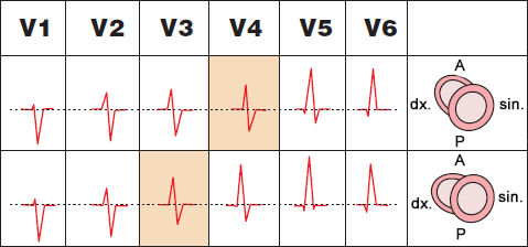 ECG normal transition zone, R and S wave voltage (R/S = 1) in V3 or V4