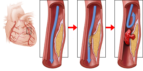 acute proximal LAD occlusion, De Winters T Waves