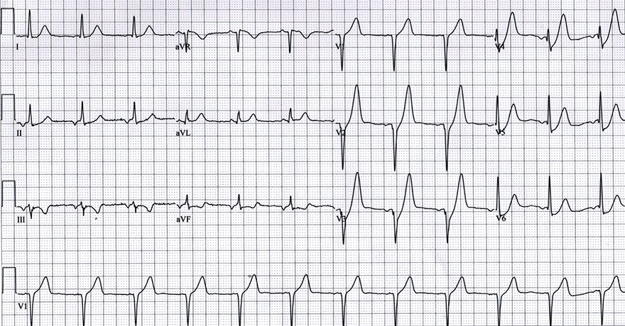 ECG De Winters T waves, upsloping ST depression with depression J point, Peaked anterior T waves, Subtle ST elevation aVR