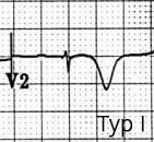 ECG Wellens syndrome type I