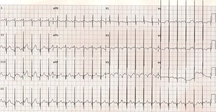 ECG biventricular hypertrophy, Katz-Wachtel phenomenon, Right axis deviation,  paediatric ECG