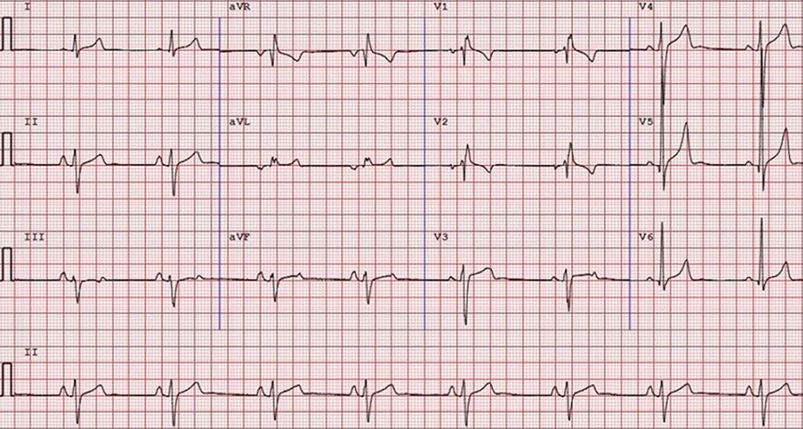 Abnormal ECG athlete complete right bundle branch block, left axis deviation,  right atrial enlargement - P pulmonale