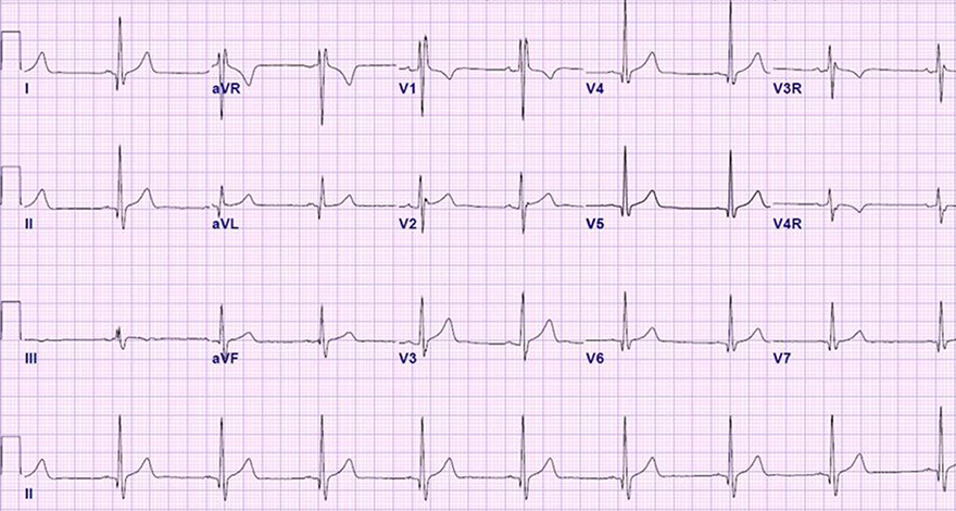 ECG athlete hypertrophic cardiomyopathy, QRS voltage criteria for LVH, deep TWI and ST segment depression, left atrial and right atrial enlargement, left axis deviation