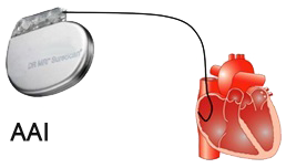 Pacemaker pacing mode AAI (NBG Pacemaker Code)