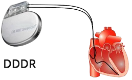 Pacemaker pacing mode DDDR (NBG Pacemaker Code)