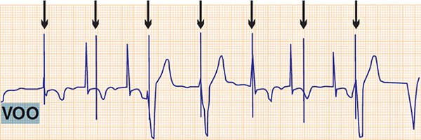 ECG asynchronous ventricular pacing mode (VOO)