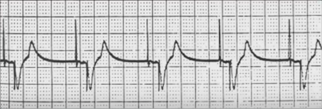 ECG DDD tracking mode ApVp (atrial pacing, ventricular pacing)