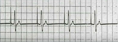 ECG DDD tracking mode ApVs (atrial pacing, ventricular sensing)