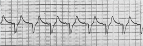 ECG P wave tracking, DDD tracking mode AsVp (atrial sensing, ventricular pacing)