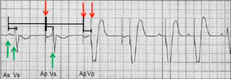 ECG pacemaker DDD tracking mode, atrial sensing (As), Ventricular sensing (Vs), Atrial pacing (Ap), Ventricular pacing (Vp)