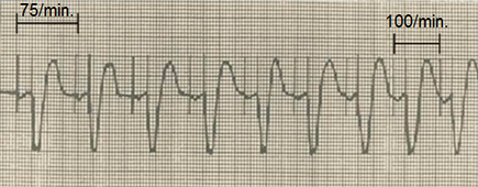 ECG pacemaker DDDR pacing mode (Rate response, Rate modulation)