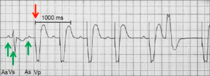 ECG pacemaker VDD pacing mode