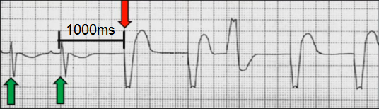 ECG pacemaker VVI mode