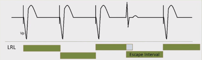 Lower Rate Limit (LRL), LRI (Lower Rate Interval)