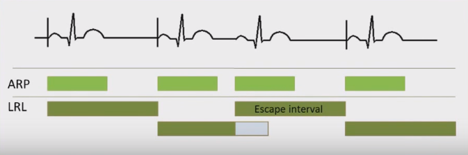 ECG pacemaker AAI mode, ARP (Atrial Refractory Period), LRL - Lower Rate Limit, escape interval